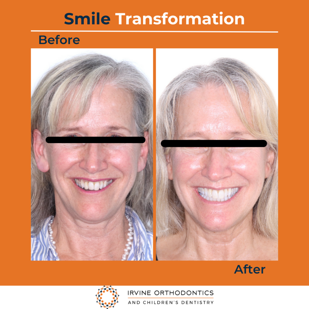 orthodontics treatment in irvine, ca before after