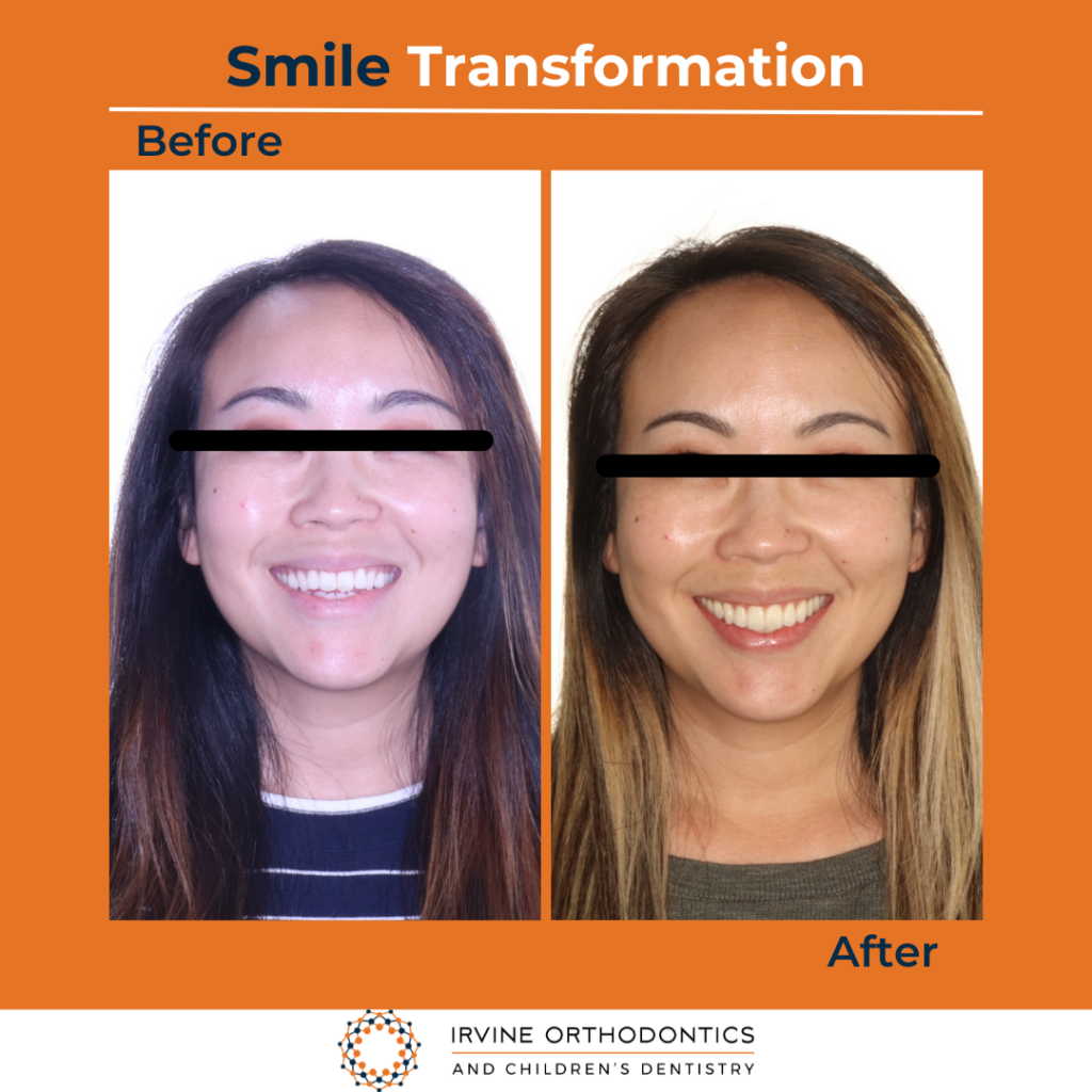 orthodontics treatment in irvine,ca